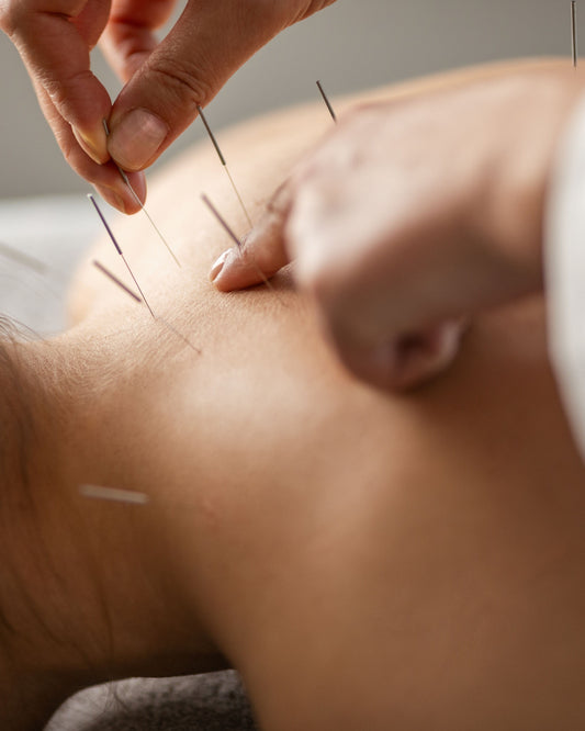 Acupuncture (60 minutes)